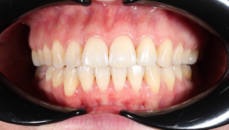 open-bite_after_2