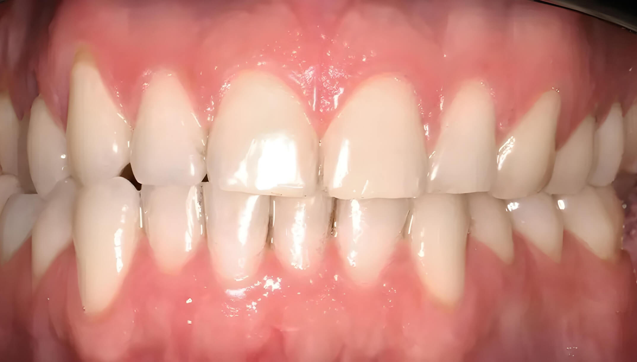 Mesial Bite #1