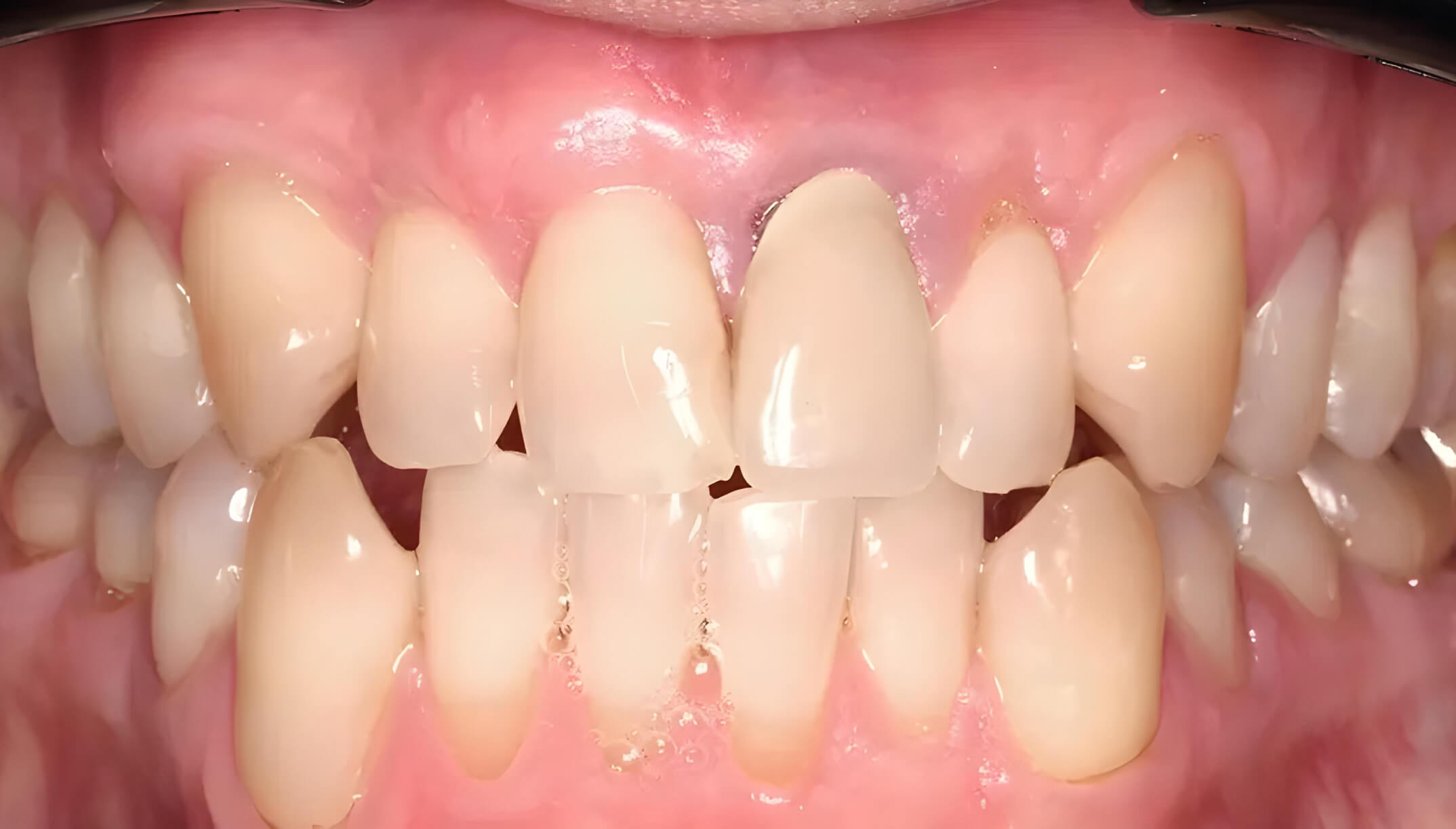 Mesial Bite #2