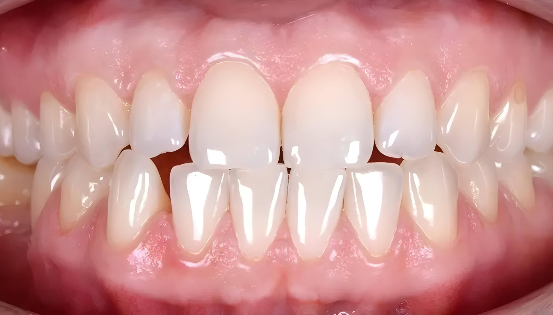 Mesial Bite #4