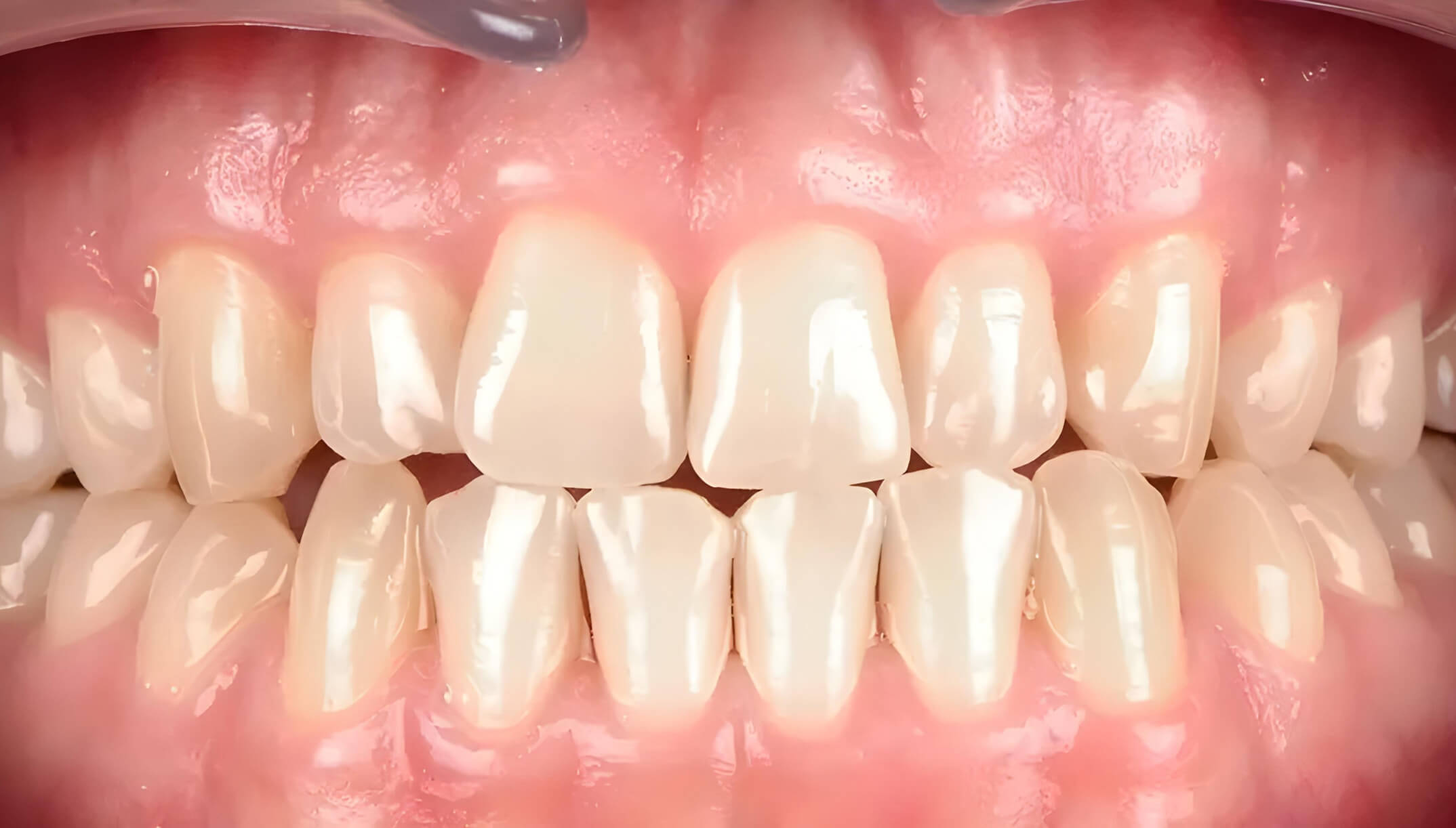 Mesial Bite #5