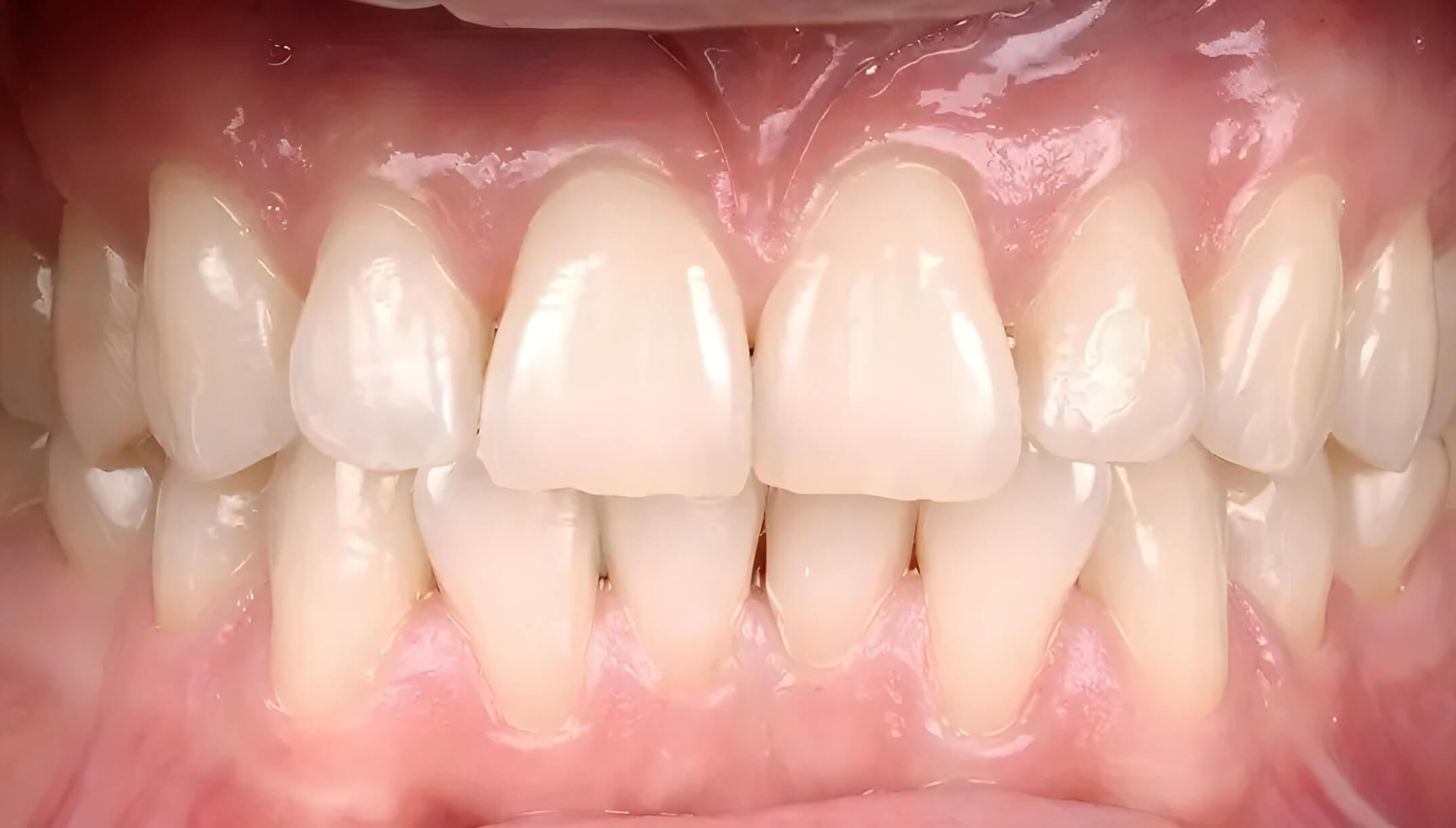 Mesial Bite #6