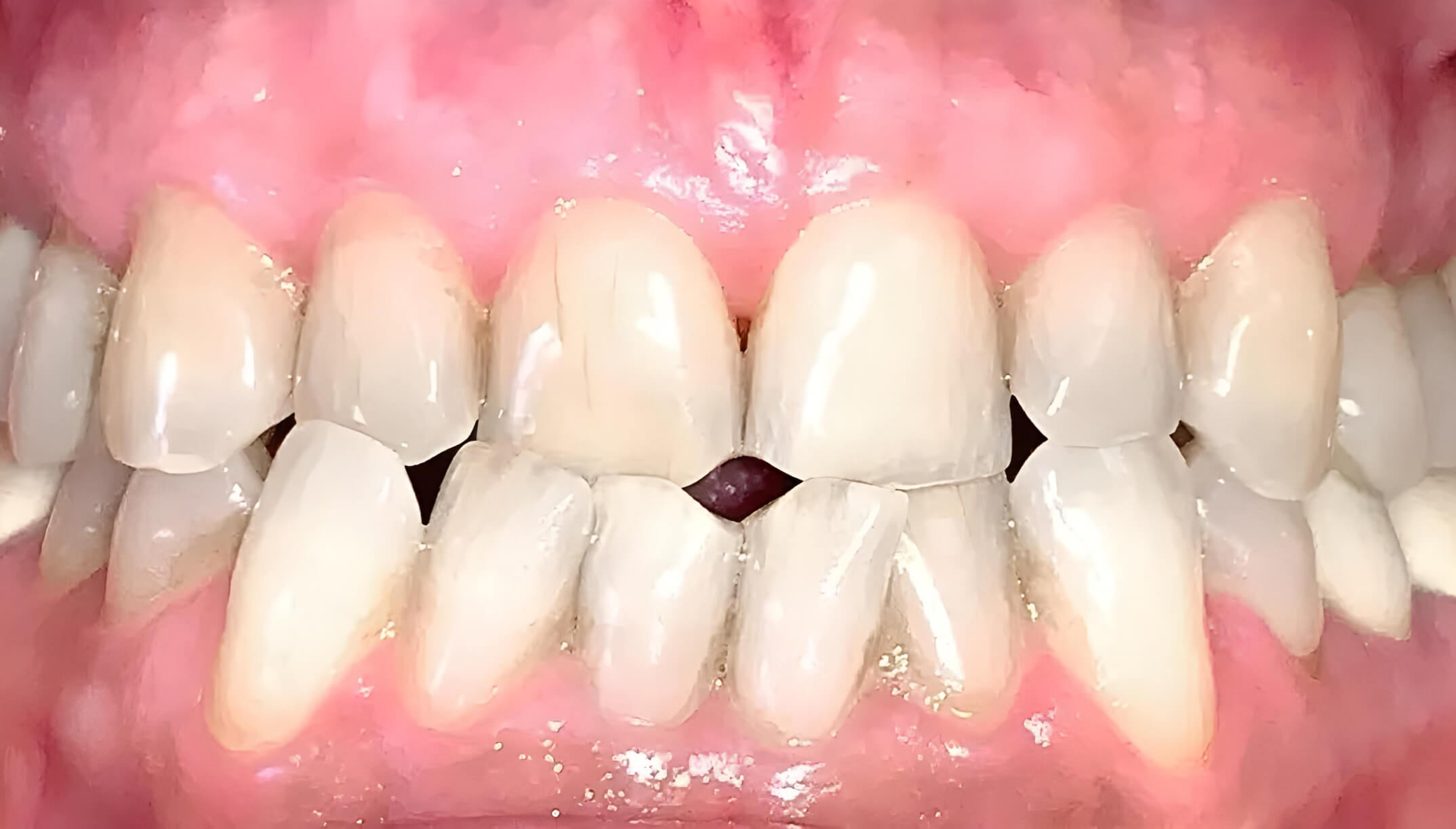 Mesial Bite #7