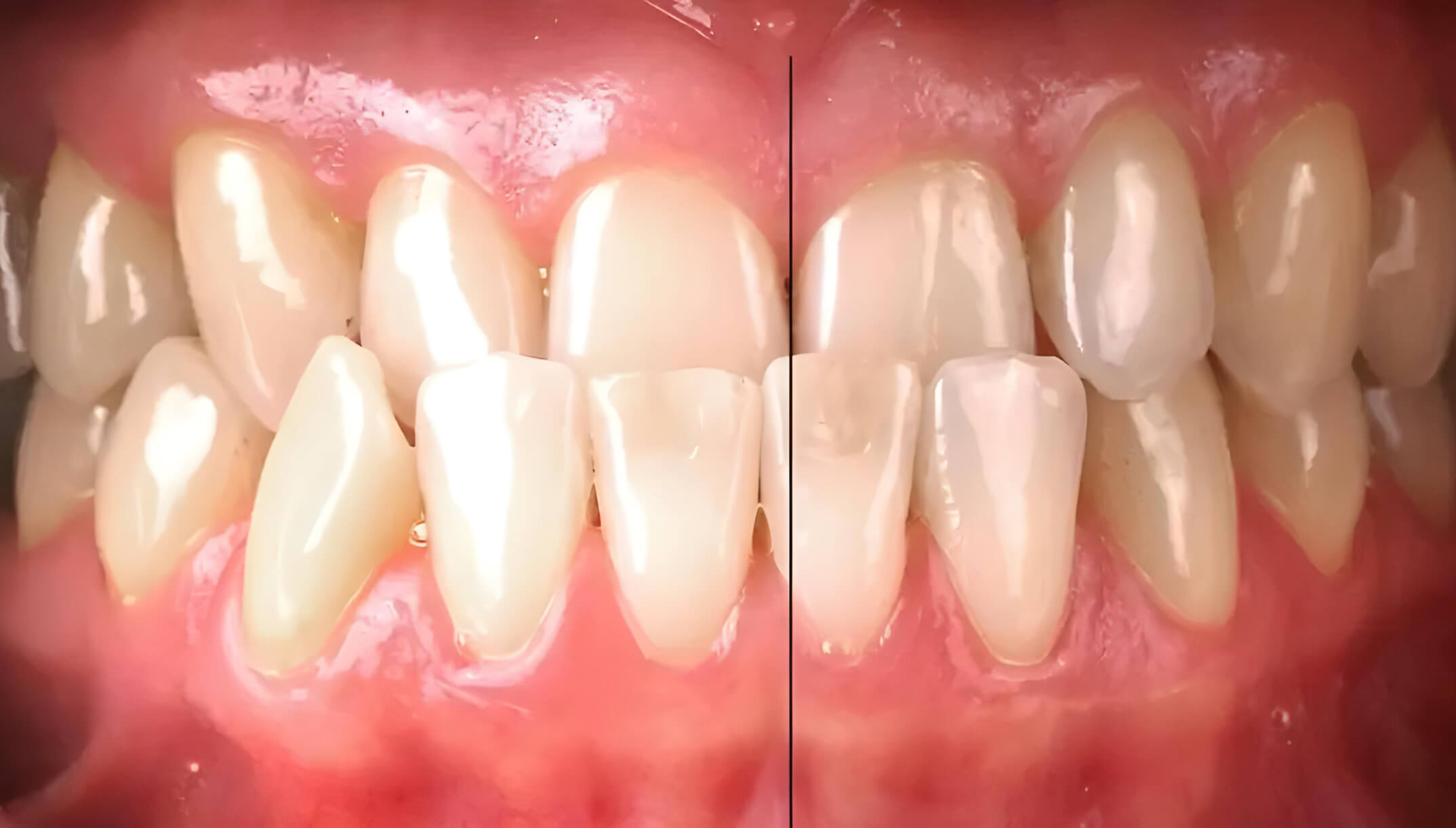 Mesial Bite #8