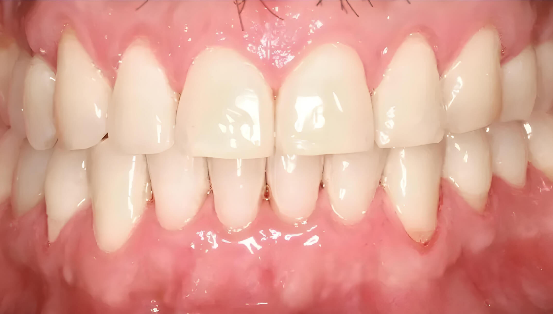 Mesial Bite #1