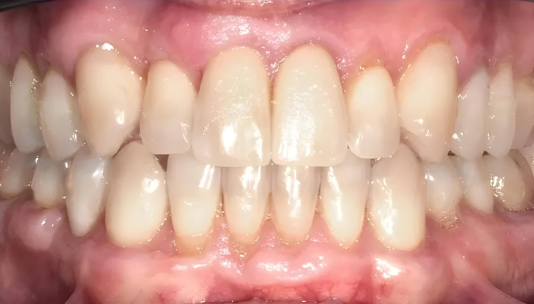 Mesial Bite #2