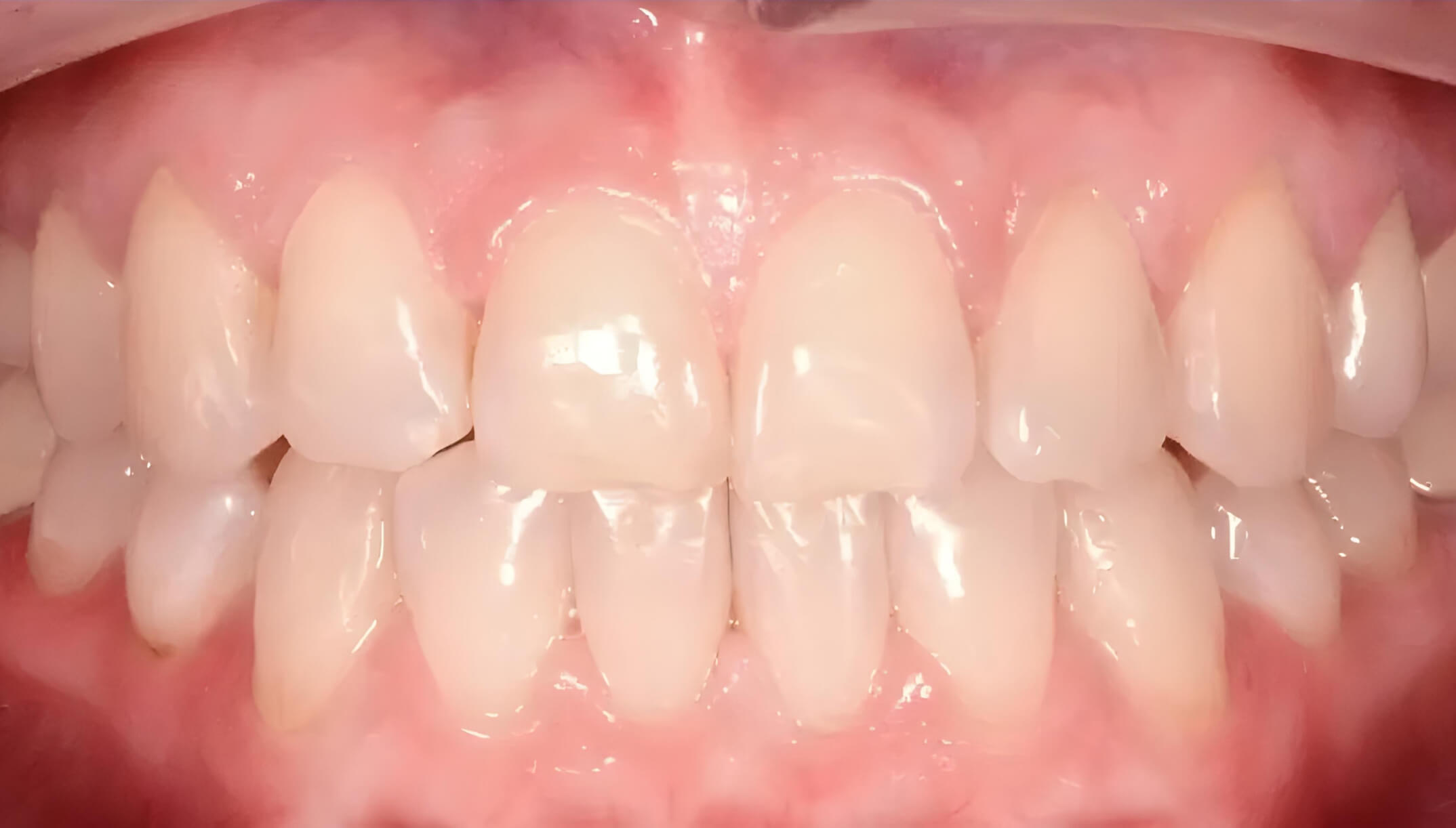 Mesial Bite #3