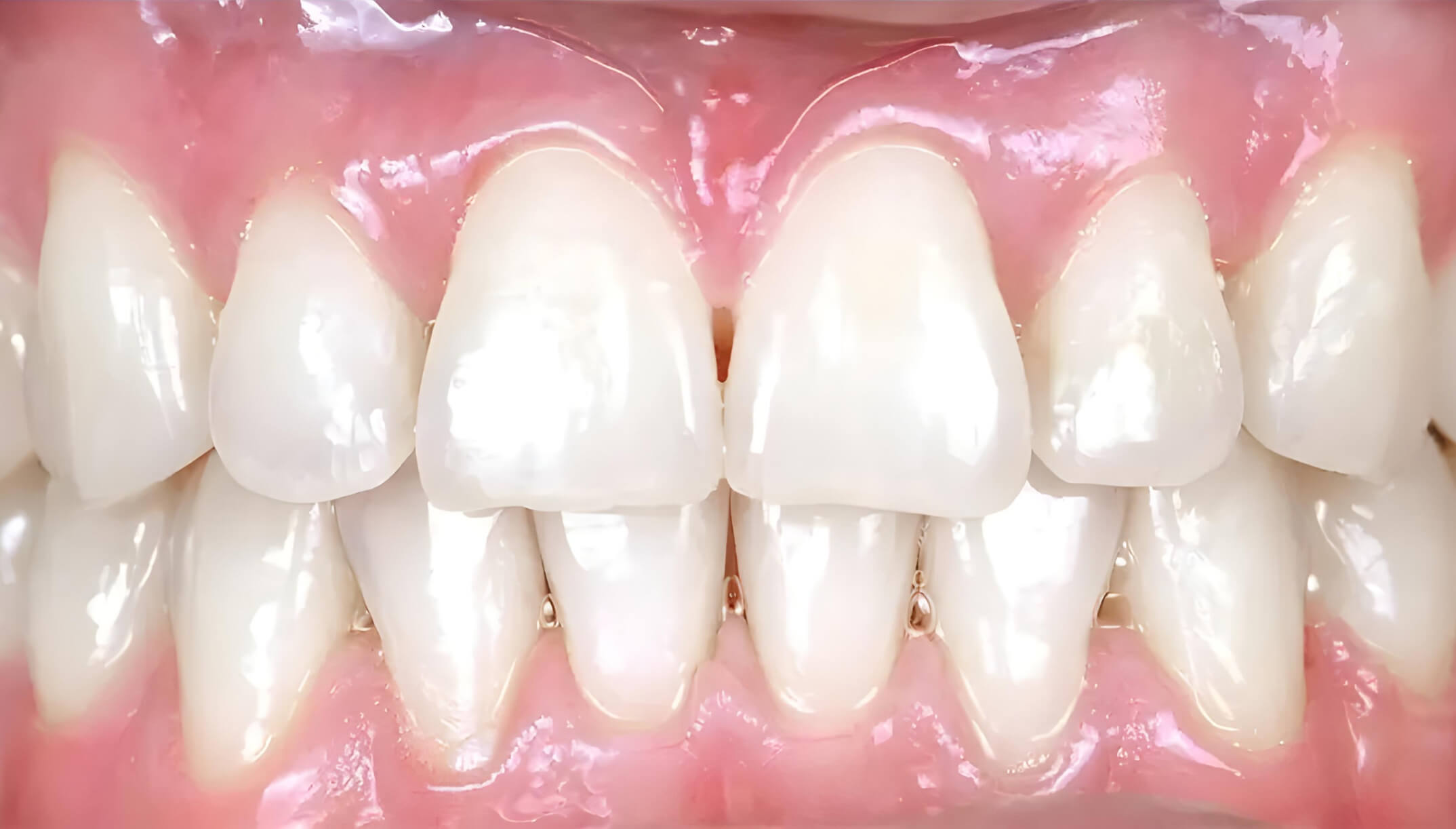 Mesial Bite #6