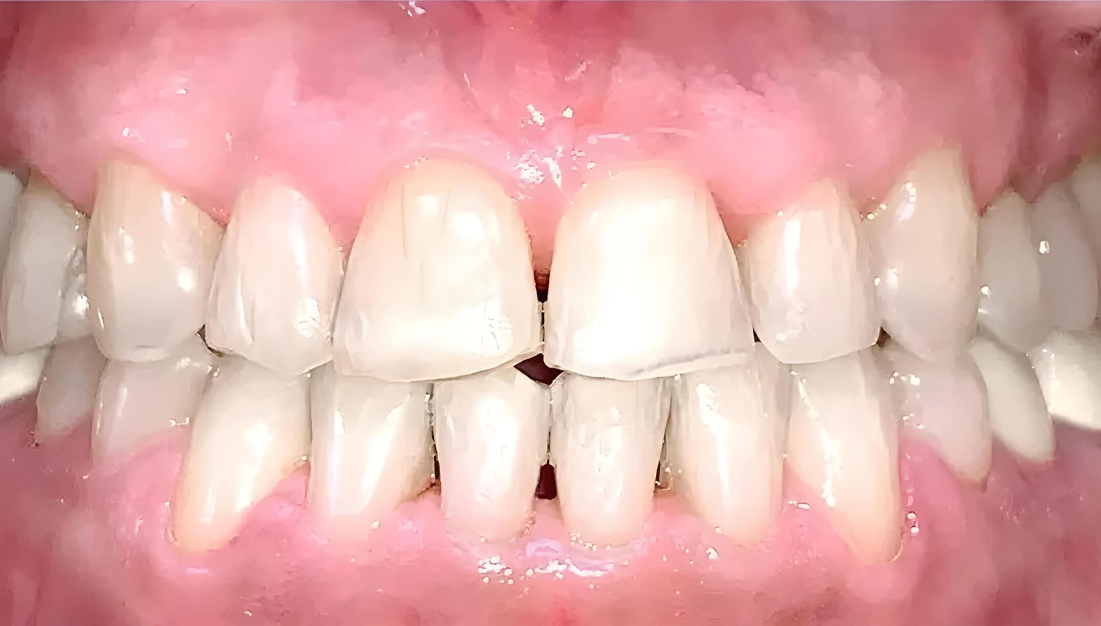 Mesial Bite #7