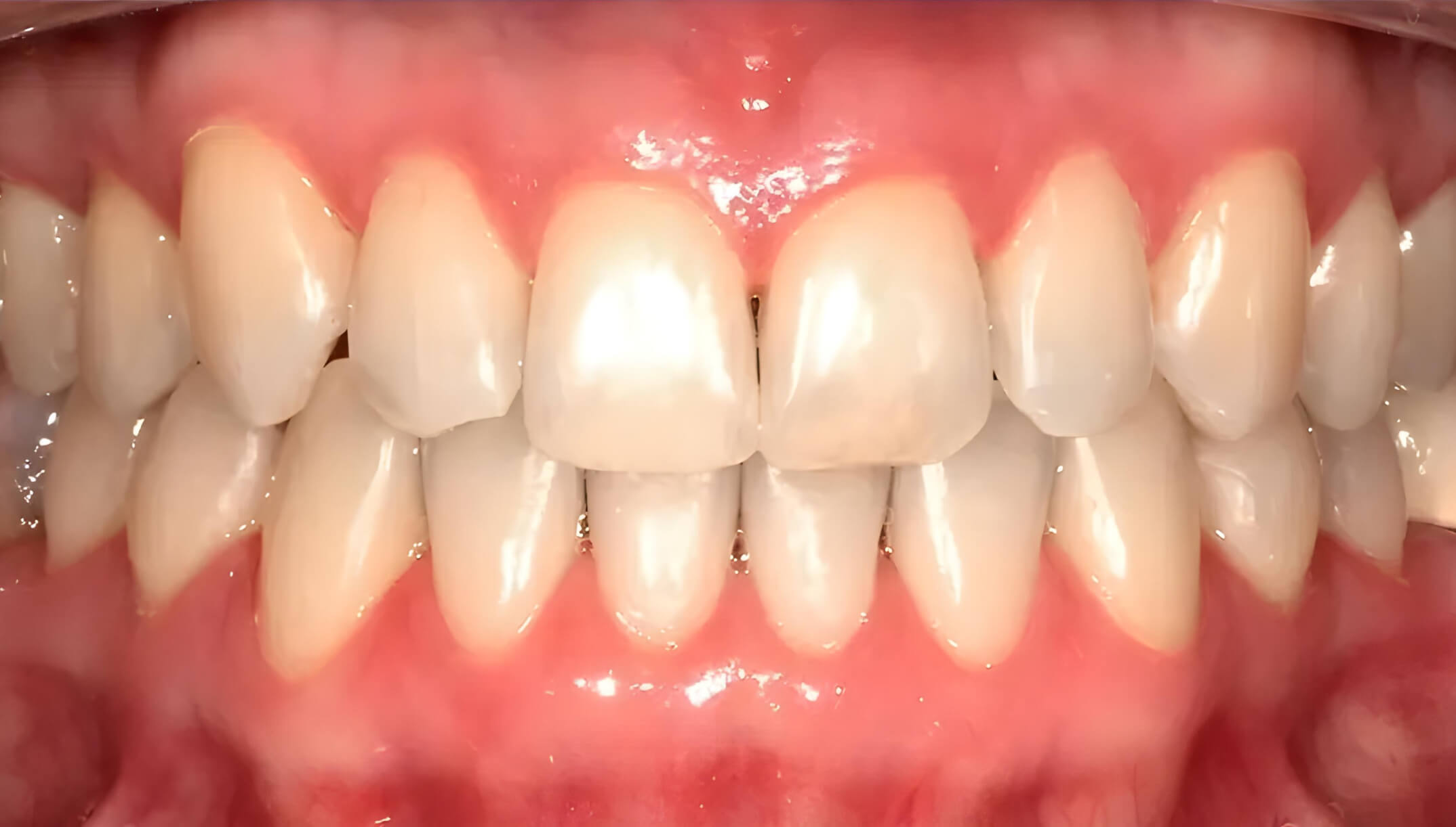 Mesial Bite #8